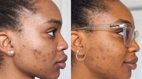 Acne Treatment For Black Skin